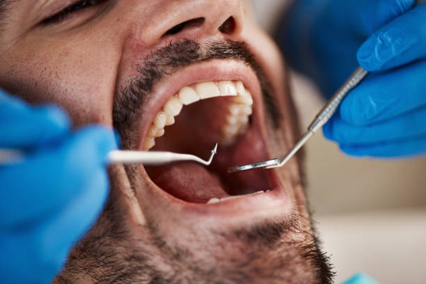 Best Emergency Wisdom Teeth Removal in Holcom, KS