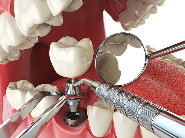 Best Emergency Dental Care for Broken or Chipped Teeth in Holcom, KS